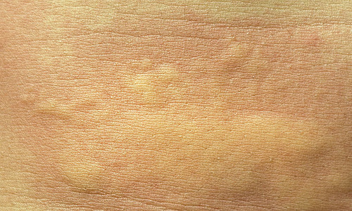 Stubborn Hives: What should we know?